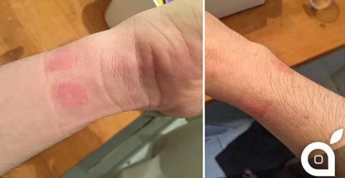Apple Watch вызывают аллергию на коже, Apple говорит, что пользователи могут носить их неправильно
